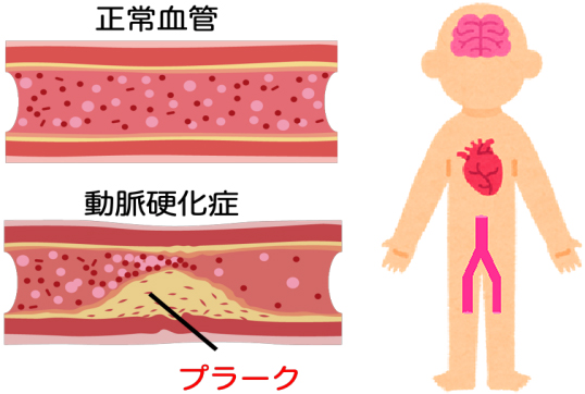 大血管合併症